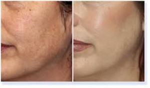 peeling chimic bucuresti