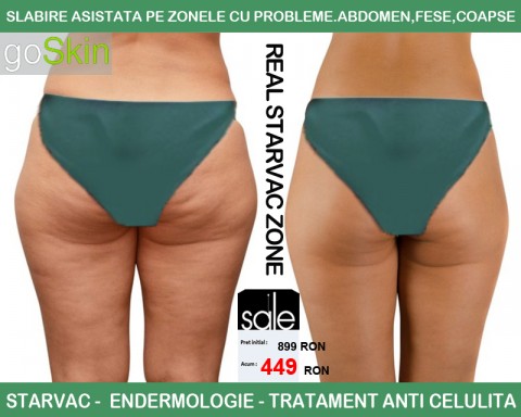 Scapa de Celulita pe Fese, Coapse si Abdomen