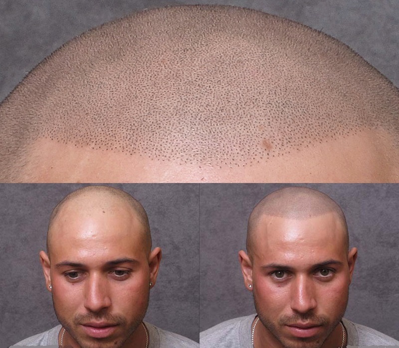 Ce trebuie sa stii despre procedura de micropigmentare scalp