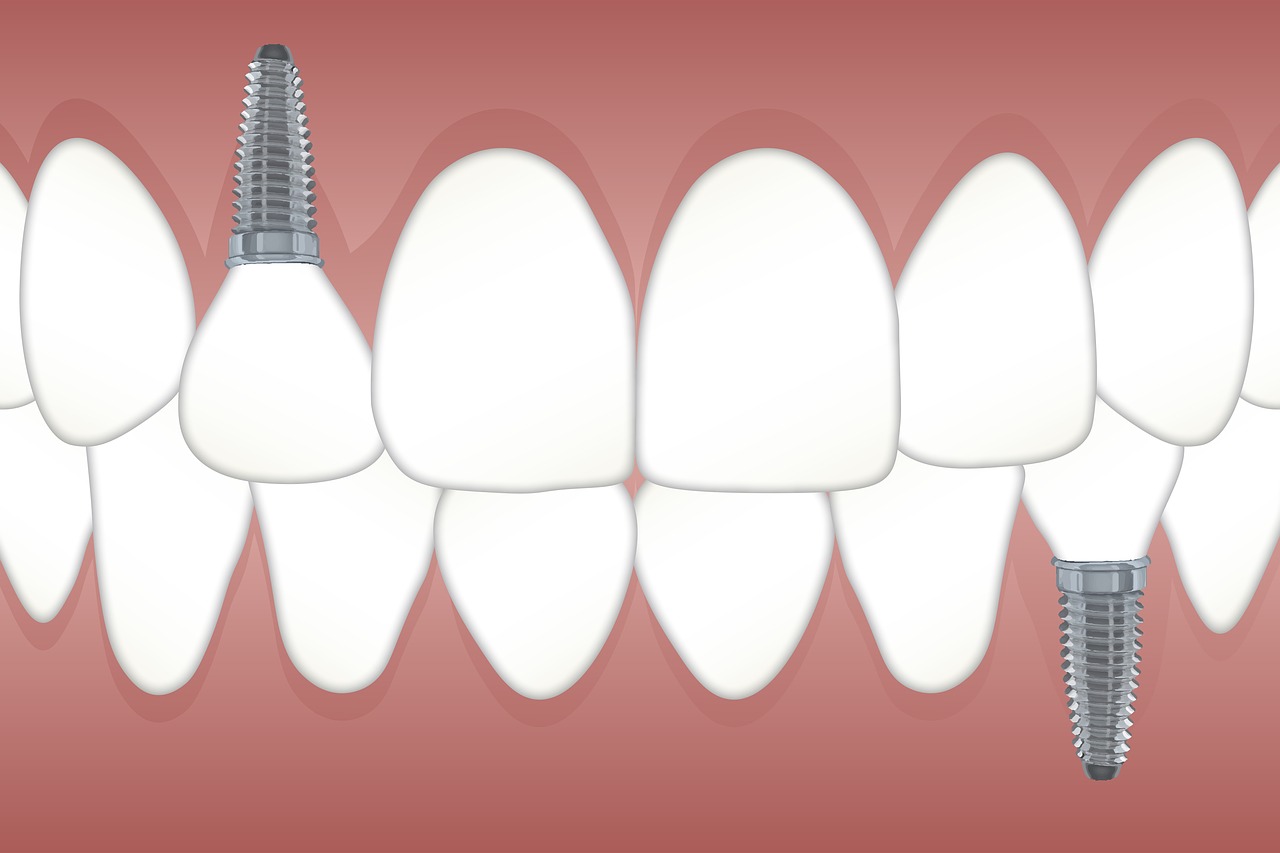 Tot ceea ce trebuie sa stii despre implantul dentar
