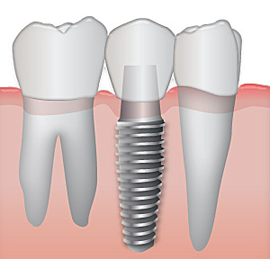 Cum ingrijesti corect un implant dentar?