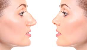 Cand este recomandata operatia de rinoplastie si ce trebuie sa stii despre ea?