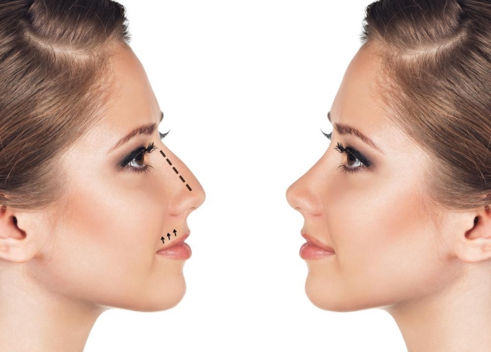 Beneficiile aduse de operatia de rinoplastie de la Russian Aesthetic