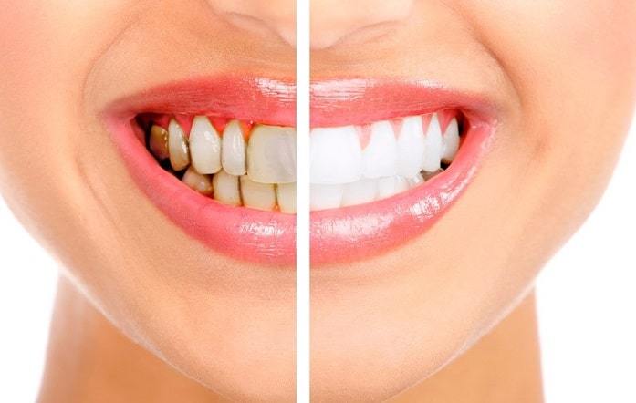 Mituri populare despre albirea dentara
