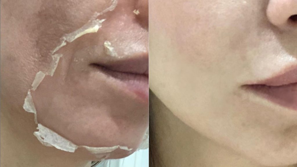 Ce ar trebui sa faci si ce nu ar trebui sa faci dupa un tratament de peeling chimic
