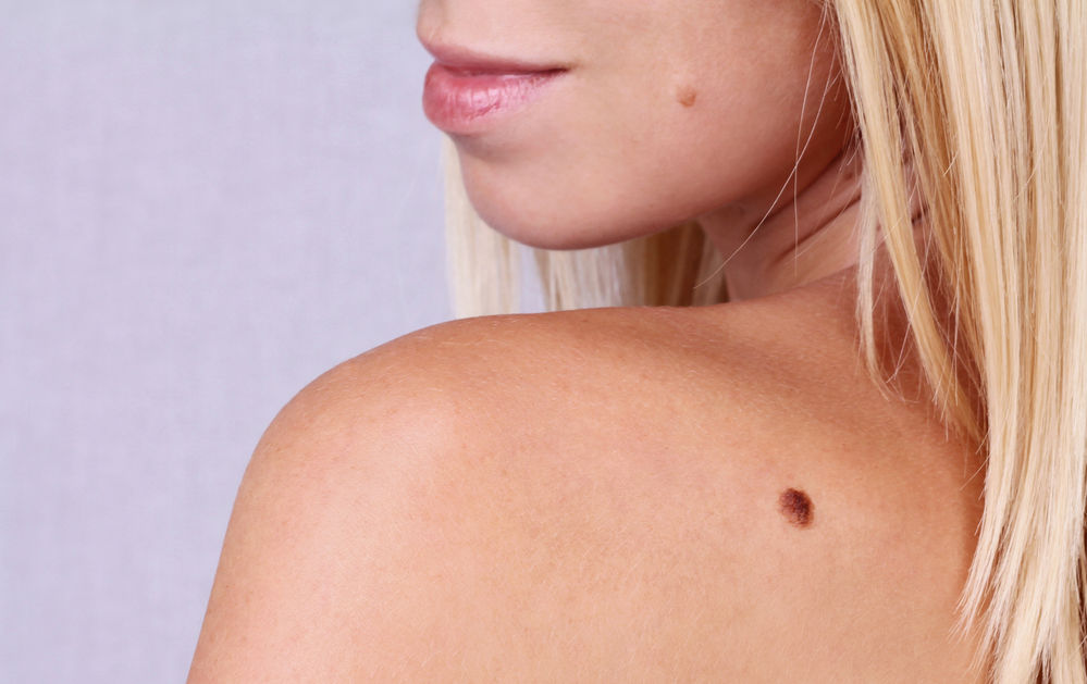 5 Motive sa mergi anual la dermatolog pentru verificarea alunitelor