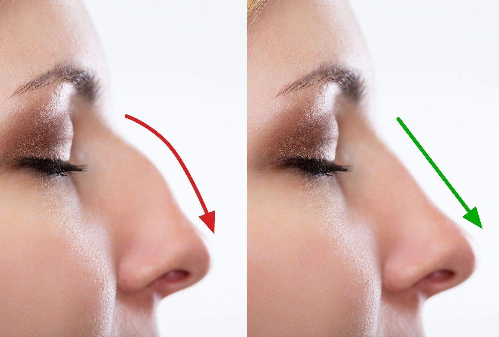 Rinoplastia Transformarea Estetica si Functionalitatea Nasului
