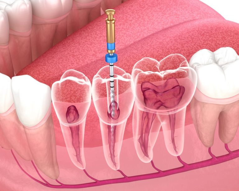 Care sunt etapele in procedura de endodontie?