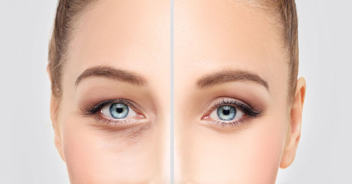 Blefaroplastia Soluția Ideală Pentru Un Look Tineresc și Odihnit