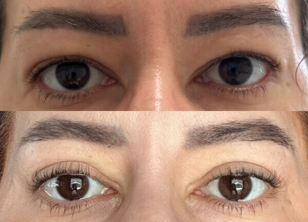 Un Nou Look, Fără Chirurgie Invazivă – Descoperiți Blefaroplastia în București