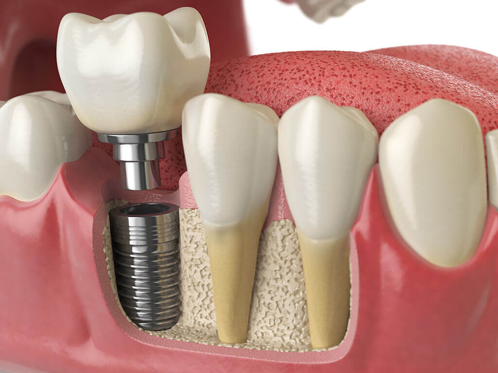 Tot ce trebuie să știți despre avantajele implanturilor dentare