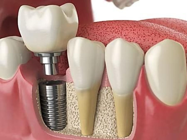 Ce trebuie să știți despre implantul dentar Alpha Bio