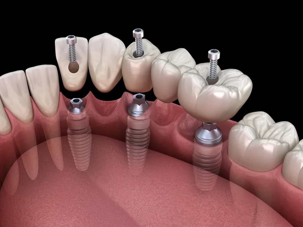 Cost implant dentar factori și diferențe între clinici din Cluj
